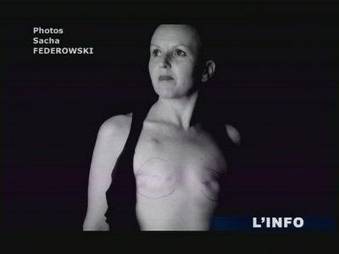 Béatrice (BRCA1)