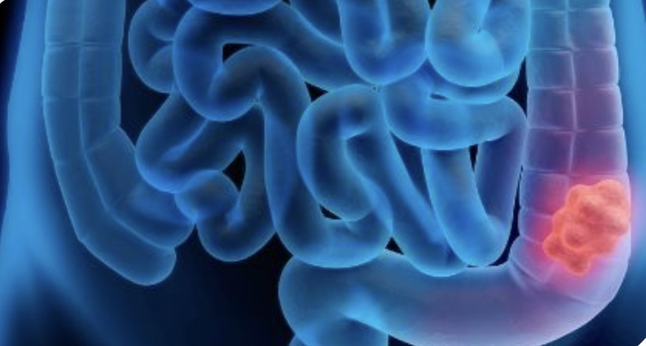 Cancer du rectum à 42 ans